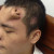 En 2013, un médecin chinois a fait pousser un nez sur le front d’un patient !