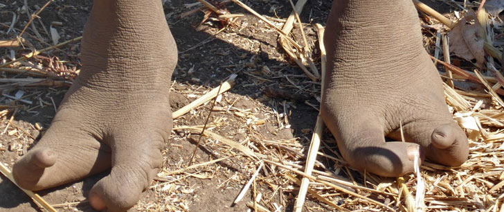 25% de la population d’une tribu au Zimbabwe sont nés avec seulement 2 orteils à chaque pied !
